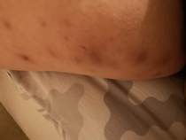 Help - boils! *PHOTOS INCLUDED*