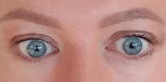 Does anyone know about upper eyelid blepharoplasty?
