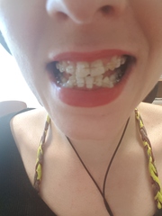 Invisalign- tell me to woman up!