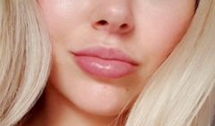 Sooo, who’s tried lip fillers?!