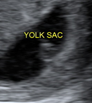 Long shot - any sonographers/obs on here please? Possible monoamniotic twins.