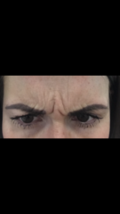For getting Botox in my 20’s?