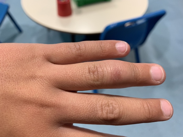 Should I go to the GP about ds’s finger?