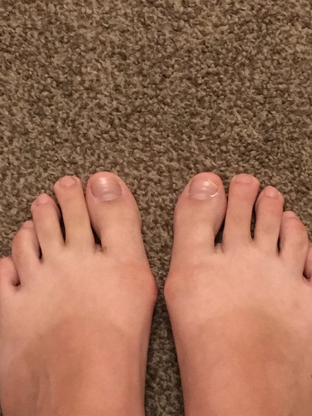Bunions! Picture of my foot attached!
