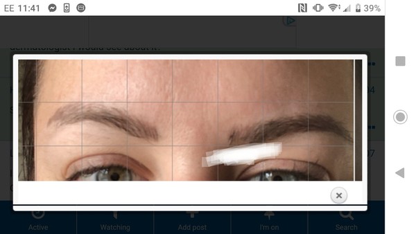 Microblading nightmare