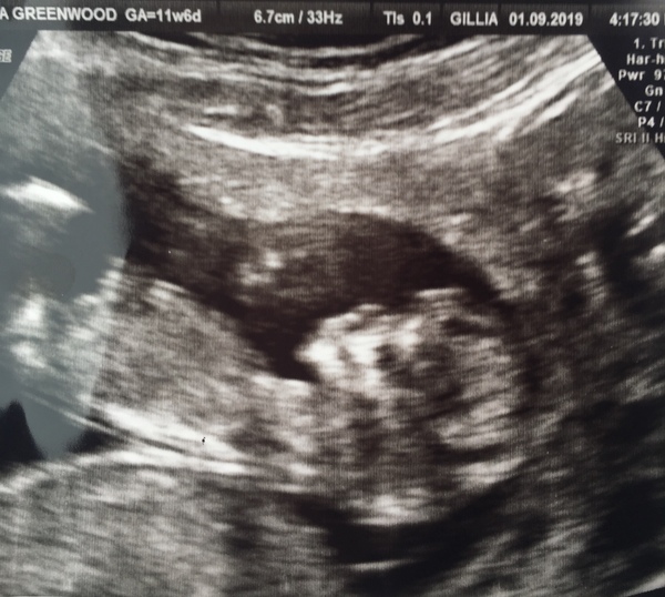 Any guesses? 12 week scan