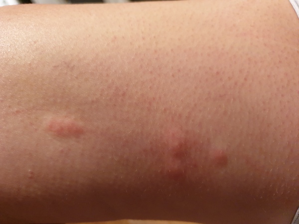 What has bitten me?