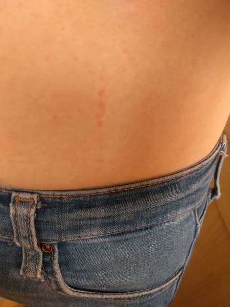 To think these are bed bug bites?