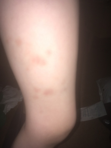 Strange bruising