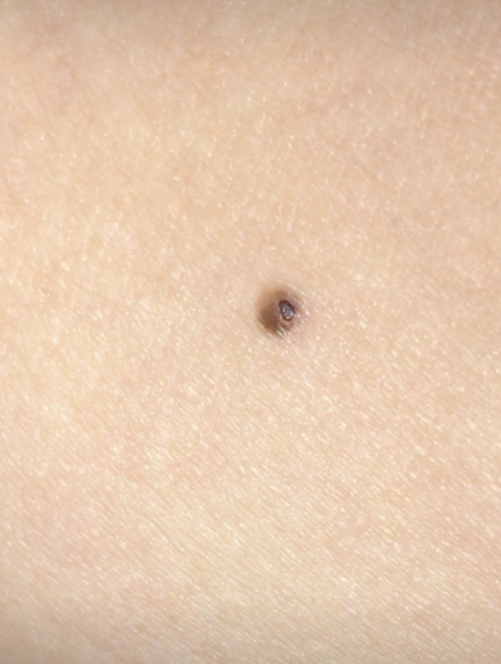 Advice please? Bothersome mole (pic attached)