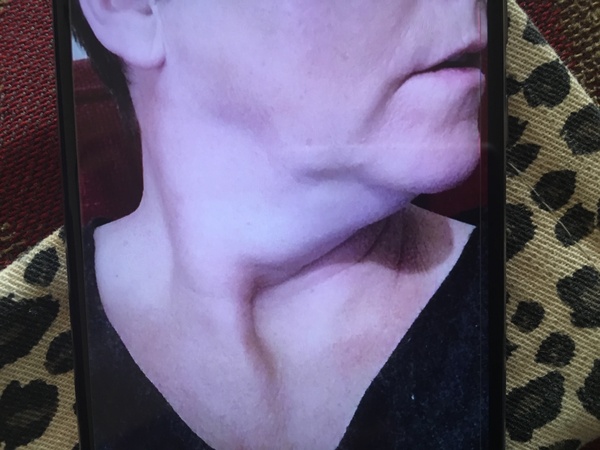 Erm anyone had any “work done” to their face?