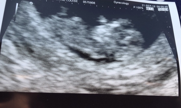 Pregnancy after Miscarriage