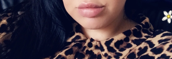Lip fillers, your experiences?