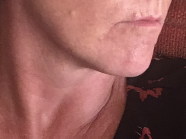 Erm anyone had any “work done” to their face?