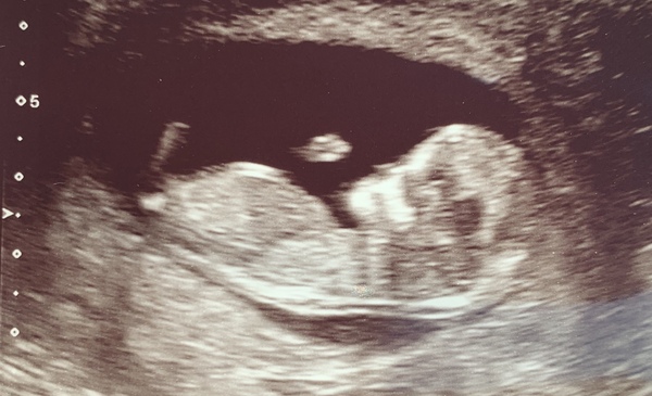 Due March 2020 - FIRST BABY in late 20's