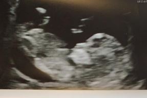 Nub Theory 12weeks pregnant