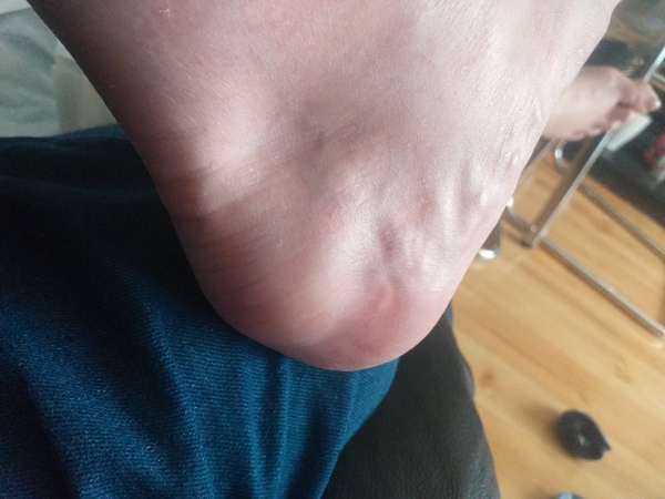 Ankle ...muscle... anyone any idea what's best to do