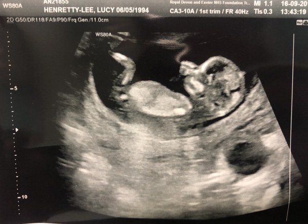 Due March 2020 - FIRST BABY in late 20's