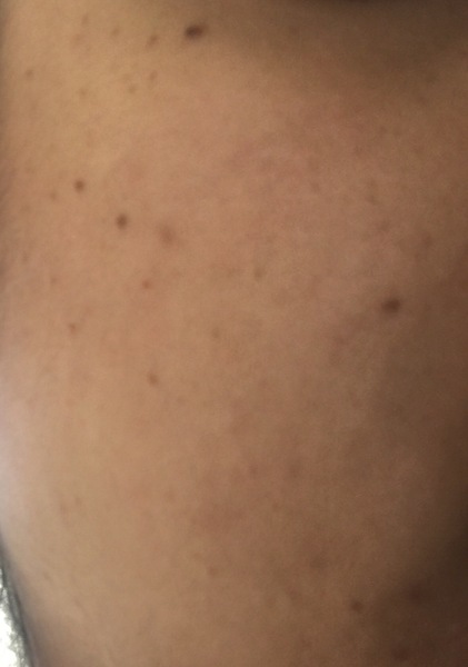 Removing sun spots/brown spots