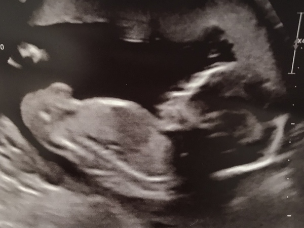 20 week scan - gender guess!