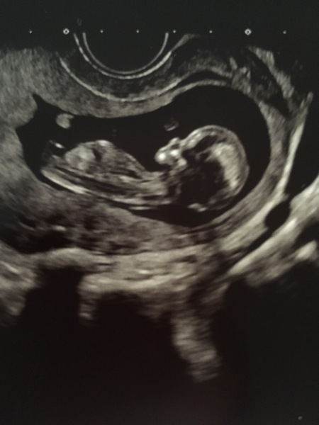 12 week scan tomorrow and PETRIFIED