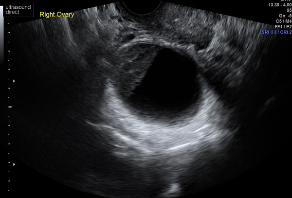 TTC and an ovarian cyst?