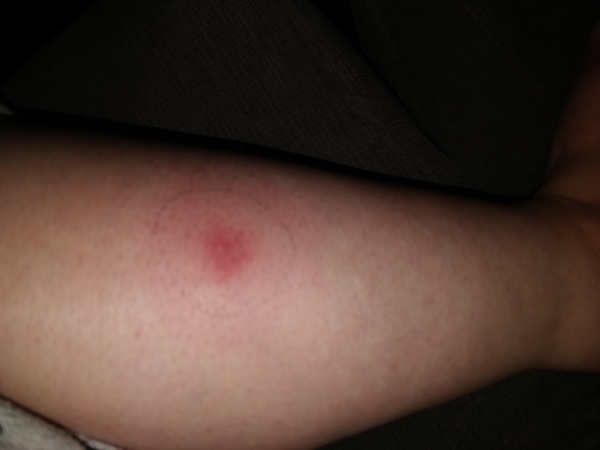 To ask if this insect bite needs treating?