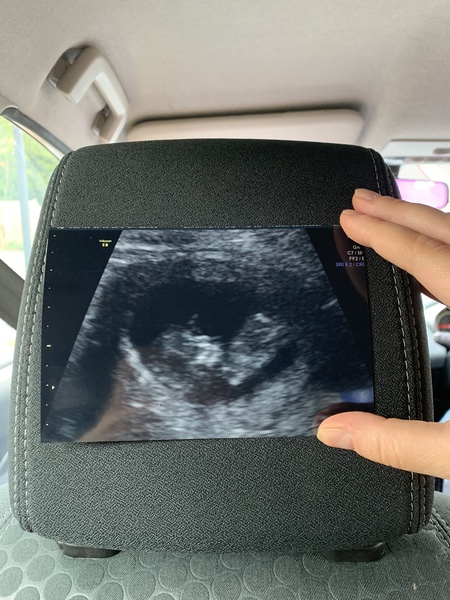 11weeks scan pic