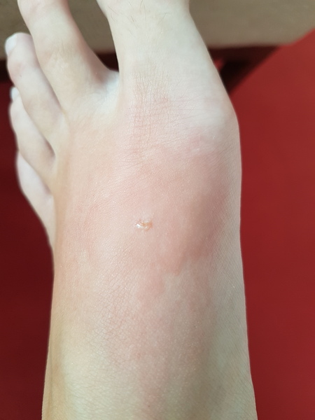 Possible lyme?