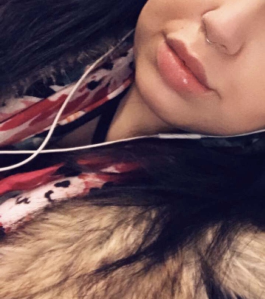 Lip fillers, your experiences?