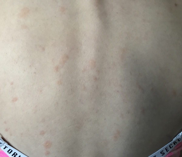 Is this chicken pox?