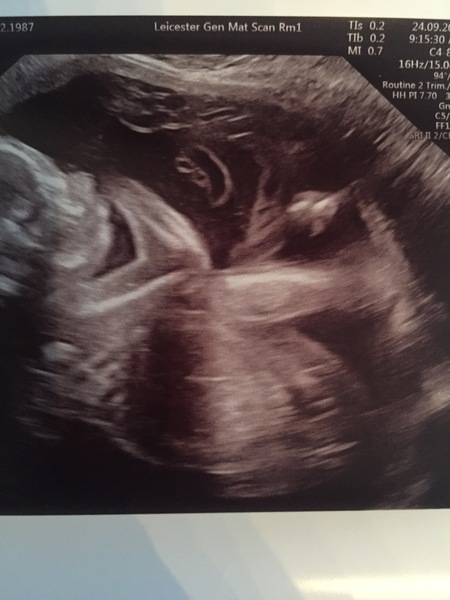 20 Weeks scan - Can you see the baby’s sex?