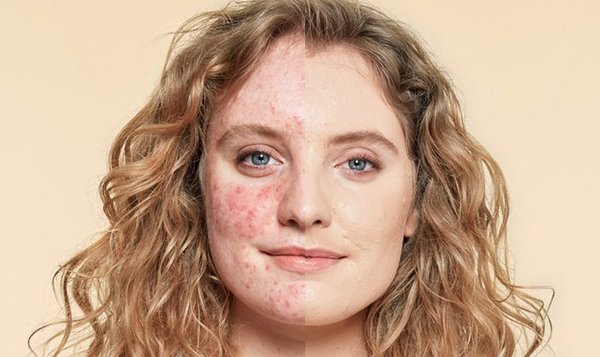Concealer that properly covers acne and scarring