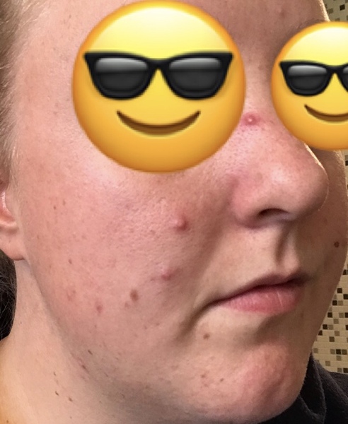 Was anyone’s first pregnancy symptoms horrific spots?! (Pic attached 😂)