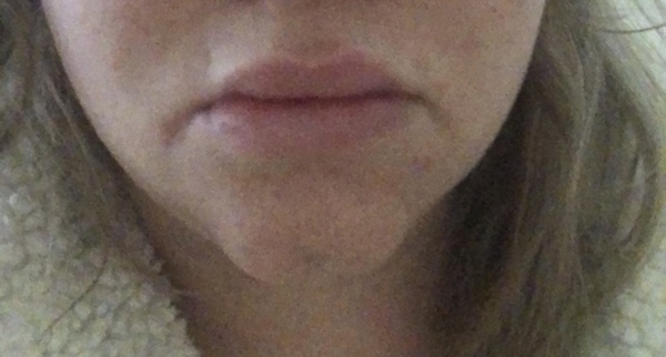 Lip fillers, your experiences?