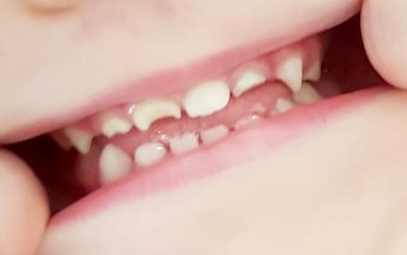 To ask people’s reassurance over 16 month olds broken tooth