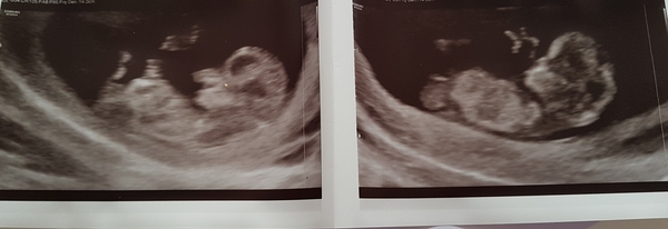 The Graduates of TTC after pregnancy loss thread #3 🐧🐧The Penguin Huddle 🐧🐧