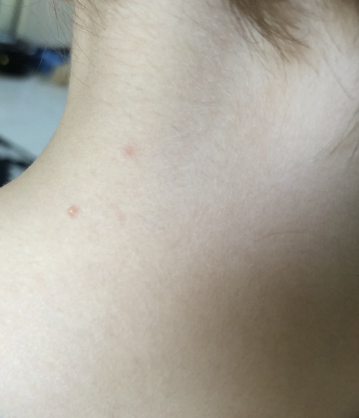 To think it isn’t chicken pox?