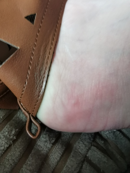 Flea bite!!
