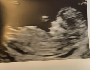 Nub Theory 12weeks pregnant