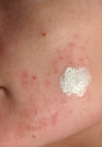 Face feels on fire. Any cooling remedies?