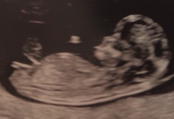 Gender guess - clear nub at 12 wks