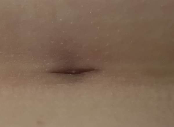 Slow healing incision