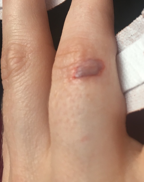 Would this cut be stitched or just left?