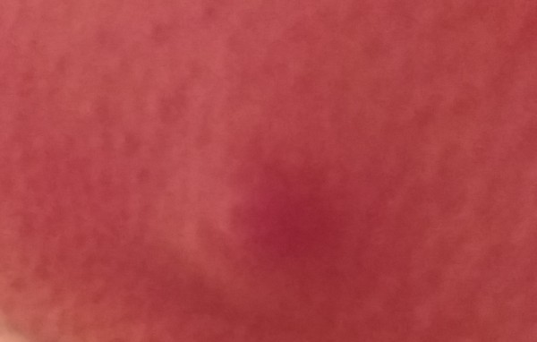 Boil on skin while on holiday in US
