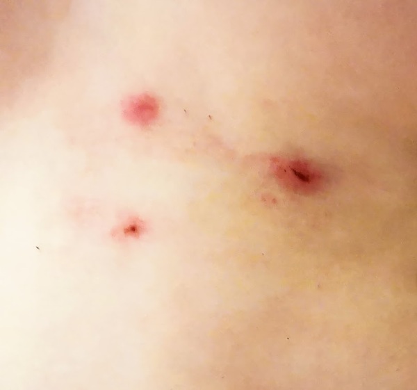 Chickenpox?