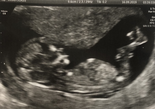 12 weeks 3 days scan. Can anyone tell the gender?