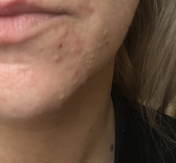 Skin break out/bumps
