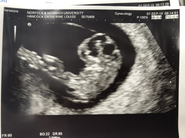Pregnancy after Miscarriage