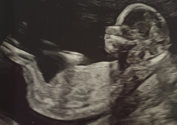 Boy or girl - any guesses